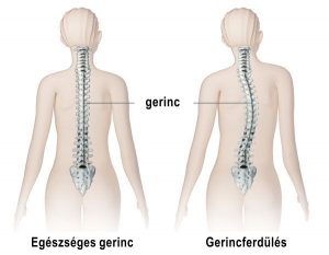 Gerincferdűlés illusztráció